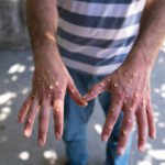 Porto Alegre confirma 1º caso de mpox em 2026 e faz alerta no Carnaval: ‘Evitar contato Porto Alegre confirma 1º caso de mpox em 2026 e faz alerta no Carnaval: ‘Evitar contato