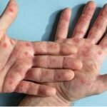 Mpox pode matar? Saiba riscos e taxa de mortalidade da doença