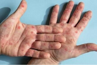 Mpox pode matar? Saiba riscos e taxa de mortalidade da doença Mpox pode matar? Saiba riscos e taxa de mortalidade da doença